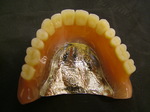 コバルトクローム床義歯