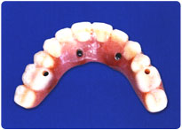 オールオン４で使用する義歯