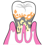 periodontal_illust[1].gif